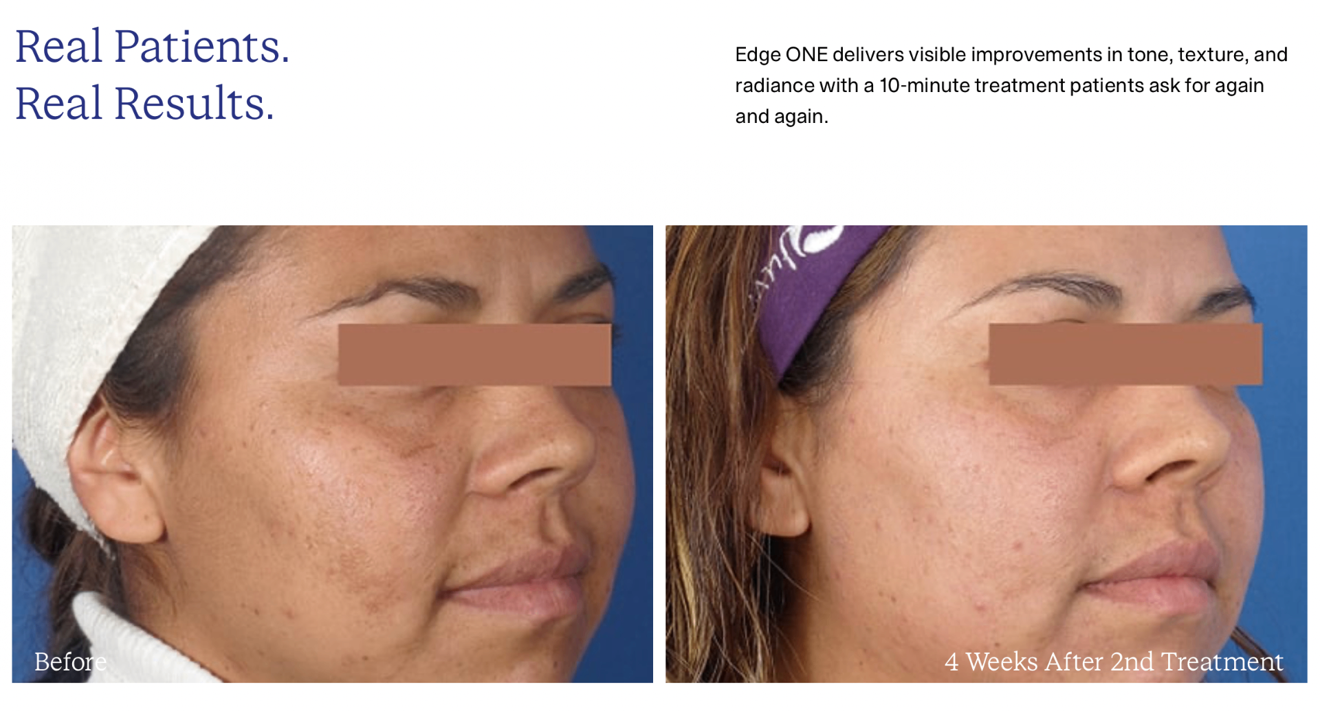 Edge ONE before and after — visible improvement in skin tone and texture after 2 treatments.